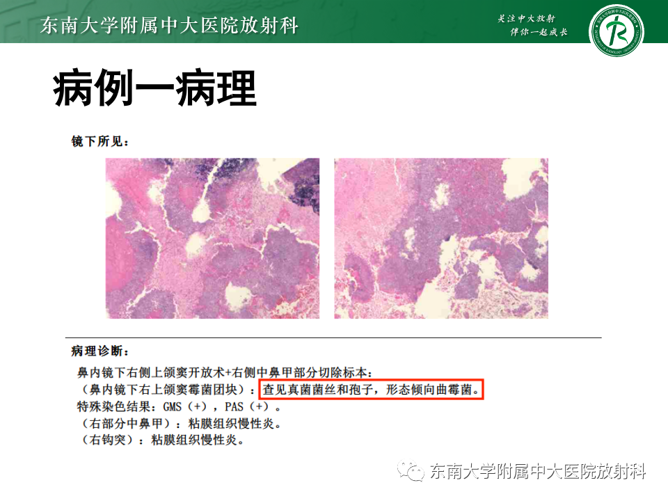 影像PPT - 【PPT】真菌性鼻窦炎-3
