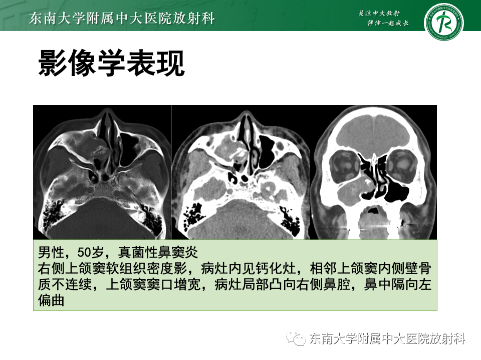 影像PPT - 【PPT】真菌性鼻窦炎-2