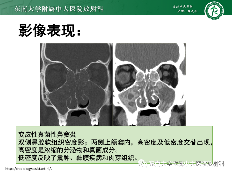 影像PPT - 【PPT】真菌性鼻窦炎-13