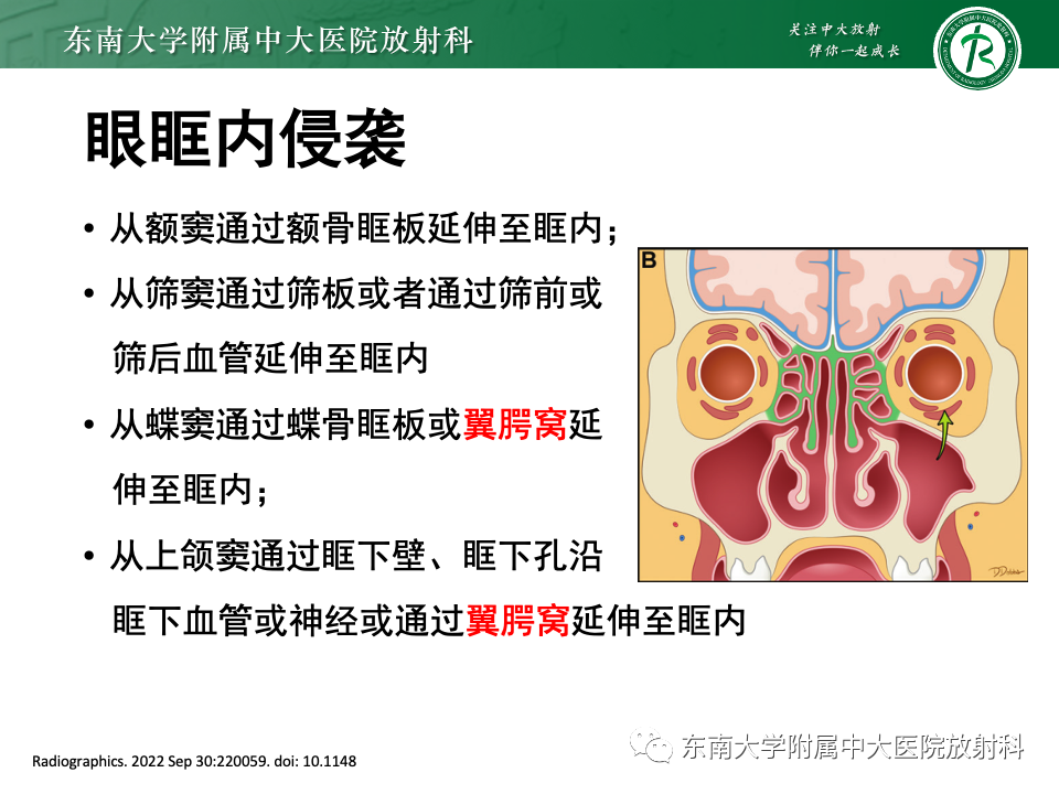 影像PPT - 【PPT】真菌性鼻窦炎-16