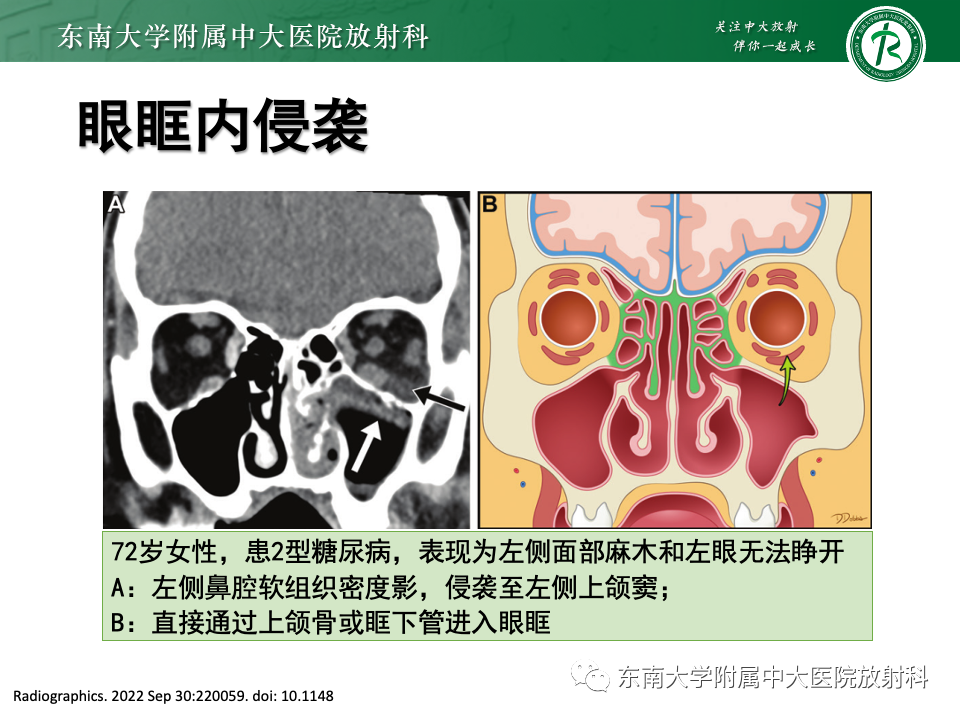 影像PPT - 【PPT】真菌性鼻窦炎-17