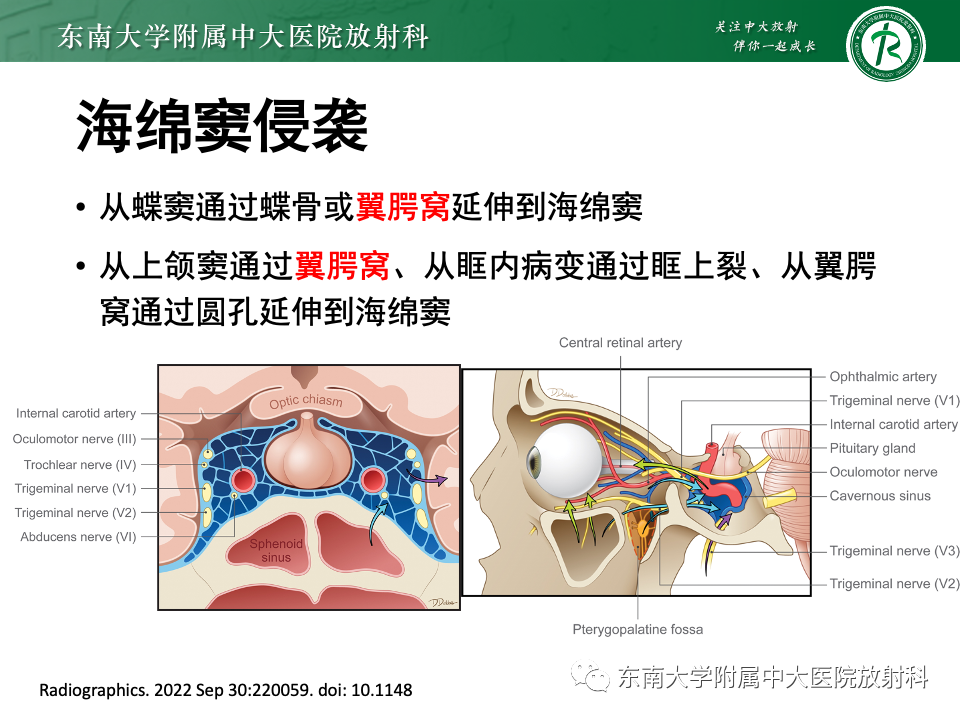 影像PPT - 【PPT】真菌性鼻窦炎-18