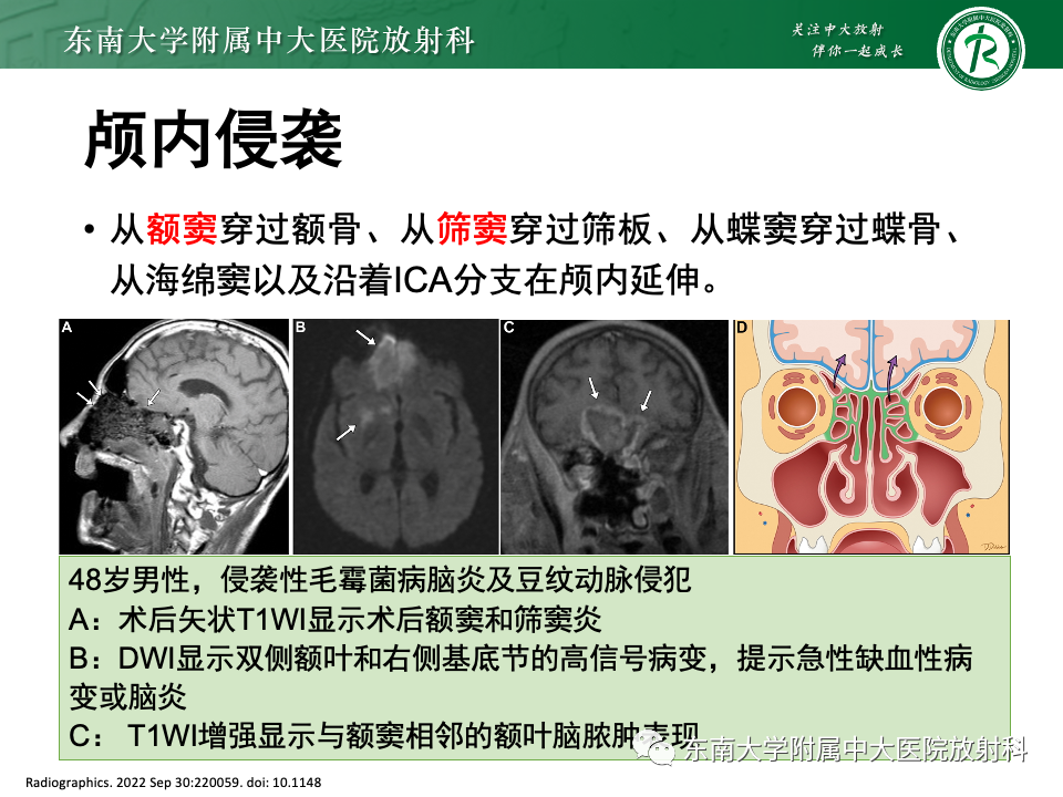 影像PPT - 【PPT】真菌性鼻窦炎-19