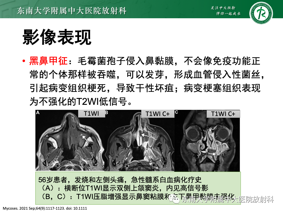 影像PPT - 【PPT】真菌性鼻窦炎-24