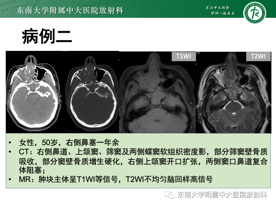 影像PPT - 【PPT】真菌性鼻窦炎-27