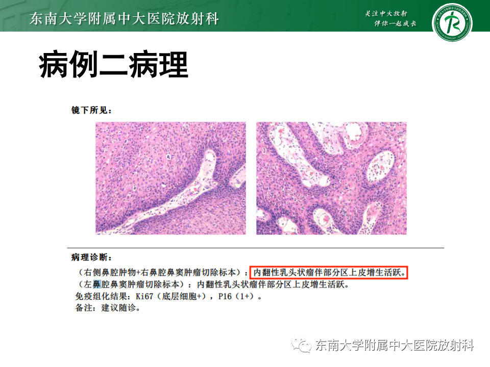 影像PPT - 【PPT】真菌性鼻窦炎-28