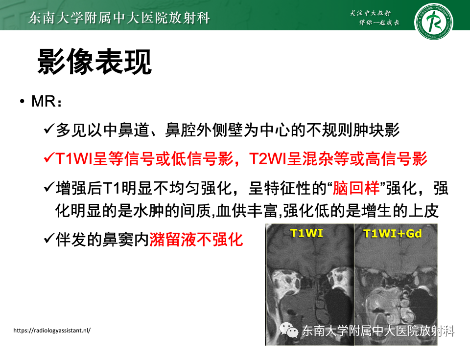 影像PPT - 【PPT】真菌性鼻窦炎-32