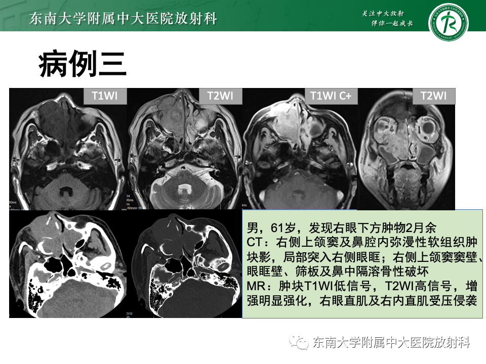 影像PPT - 【PPT】真菌性鼻窦炎-33