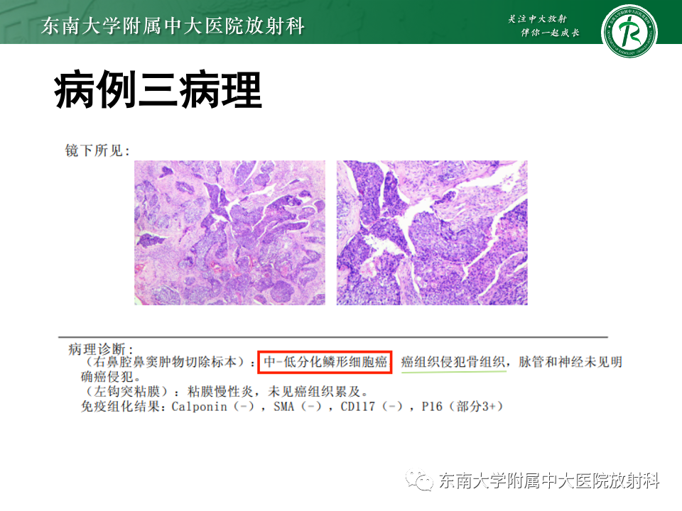 影像PPT - 【PPT】真菌性鼻窦炎-34