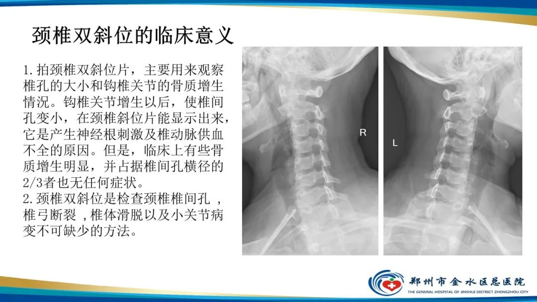 影像PPT - 【PPT】颈椎拍片技术与临床意义-21