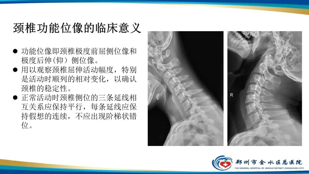 影像PPT - 【PPT】颈椎拍片技术与临床意义-24
