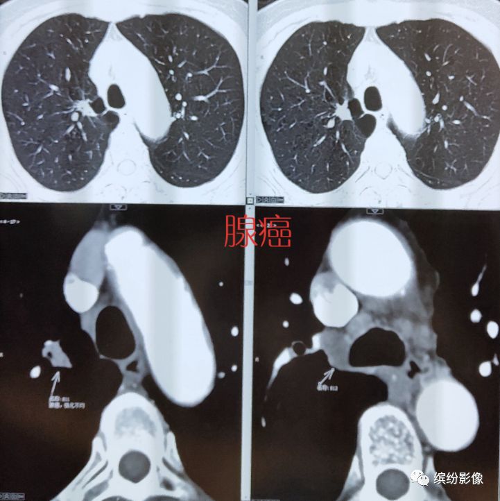 影像PPT - 肺癌病例读片解析-5 影像PPT - 肺癌病例读片解析-5