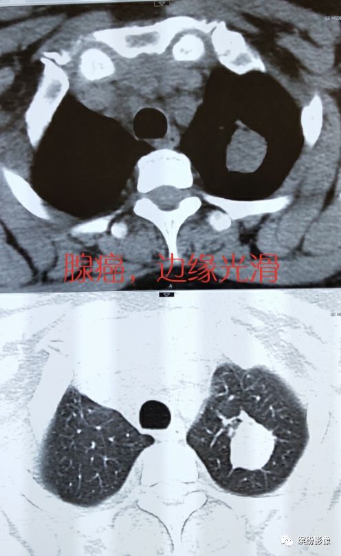 影像PPT - 肺癌病例读片解析-12 影像PPT - 肺癌病例读片解析-12
