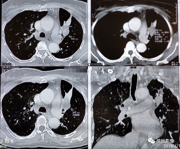 影像PPT - 肺癌病例读片解析-15 影像PPT - 肺癌病例读片解析-15