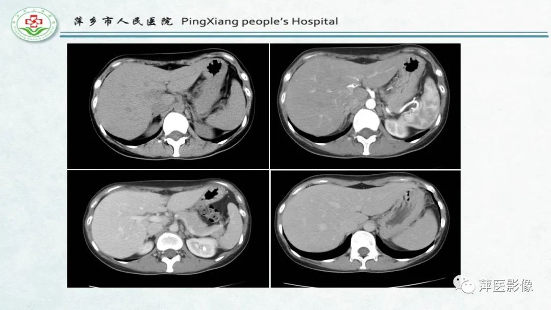 影像PPT - 【PPT】HCC影像诊断思路-8