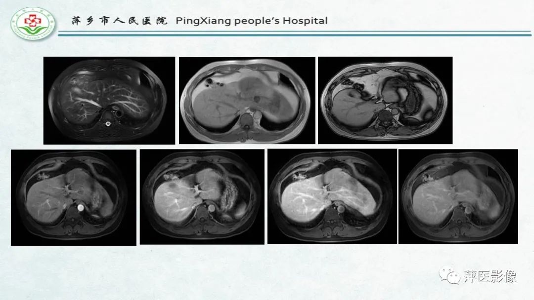影像PPT - 【PPT】HCC影像诊断思路-11