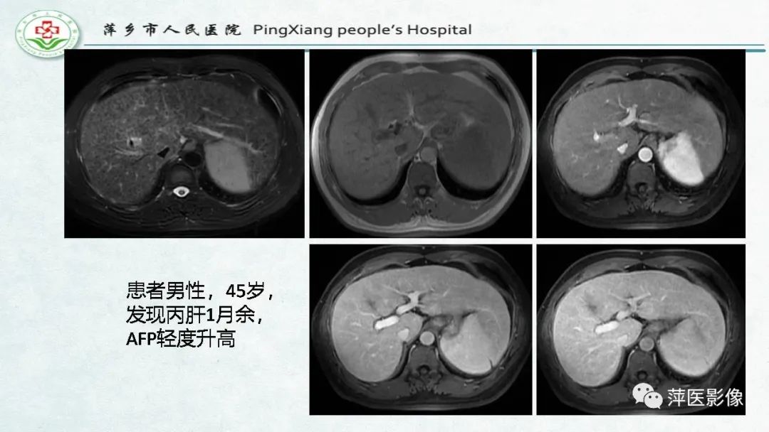 影像PPT - 【PPT】HCC影像诊断思路-23