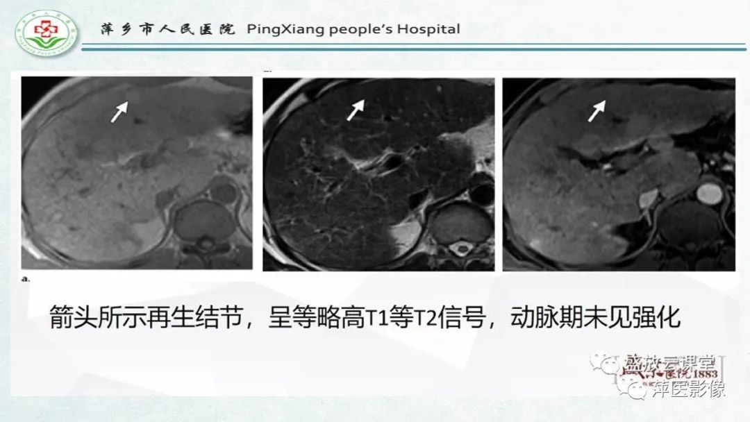 影像PPT - 【PPT】HCC影像诊断思路-22
