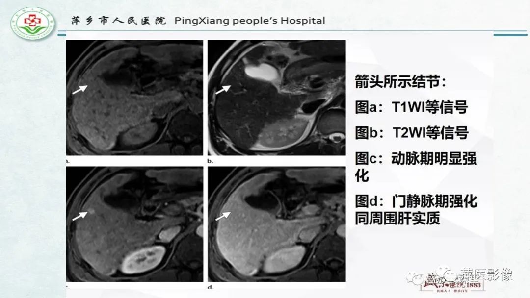 影像PPT - 【PPT】HCC影像诊断思路-26