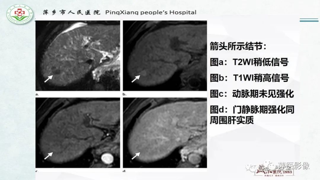 影像PPT - 【PPT】HCC影像诊断思路-27