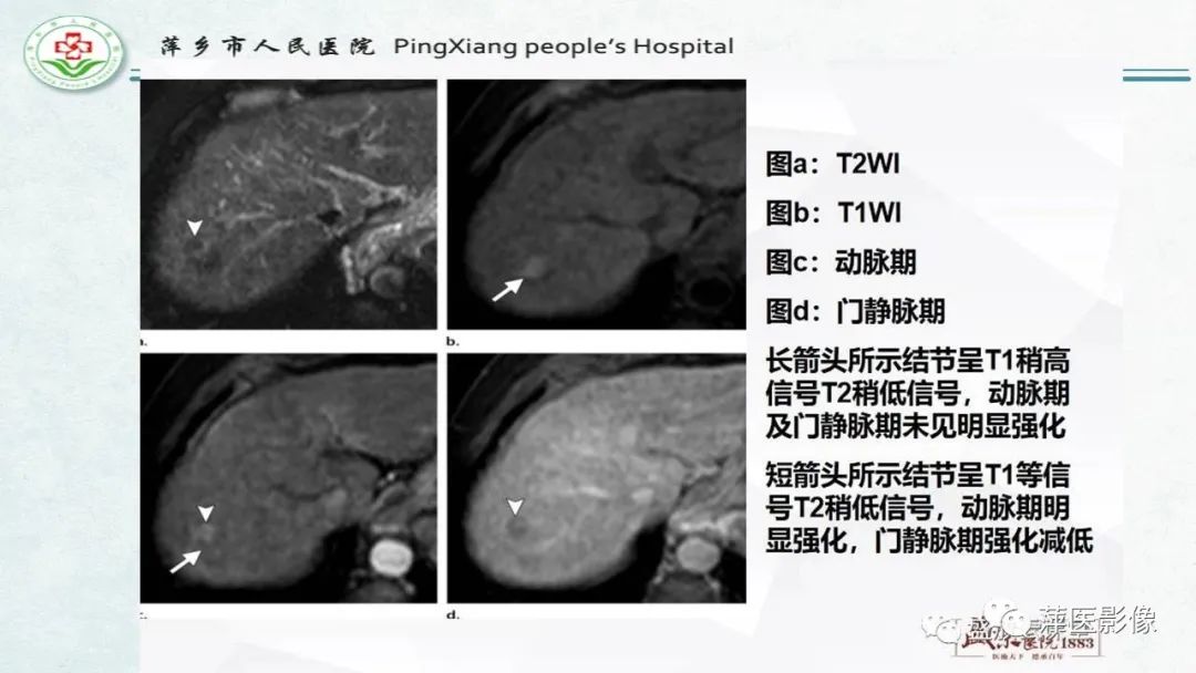 影像PPT - 【PPT】HCC影像诊断思路-28