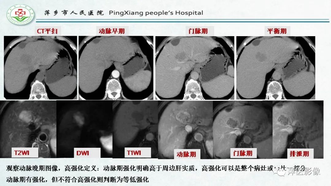 影像PPT - 【PPT】HCC影像诊断思路-35