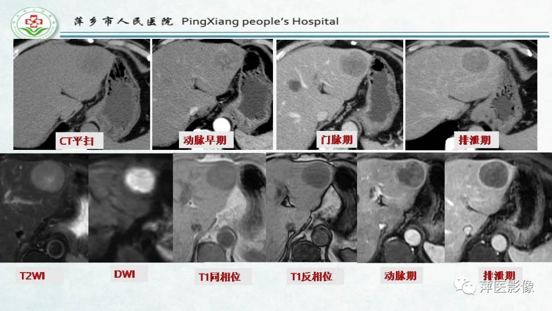 影像PPT - 【PPT】HCC影像诊断思路-36