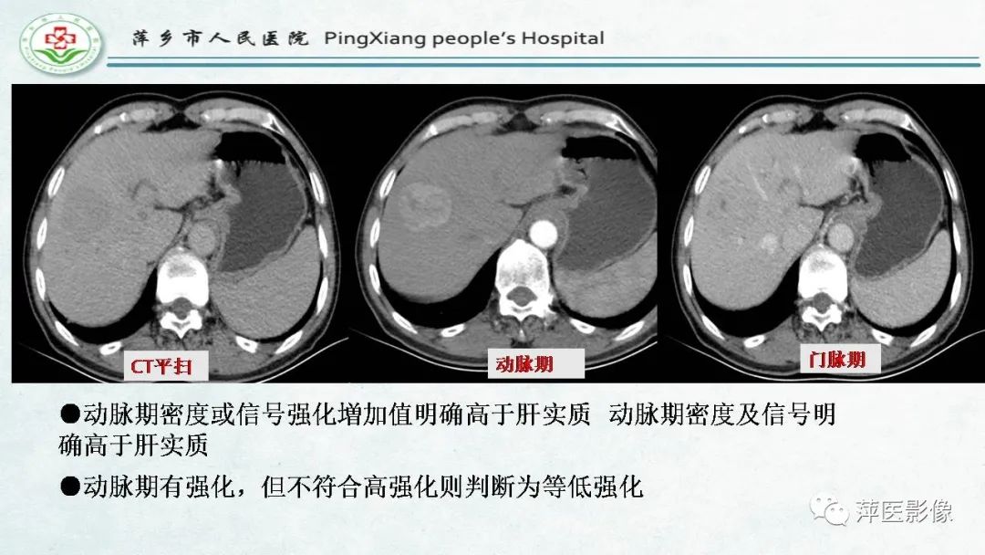 影像PPT - 【PPT】HCC影像诊断思路-37