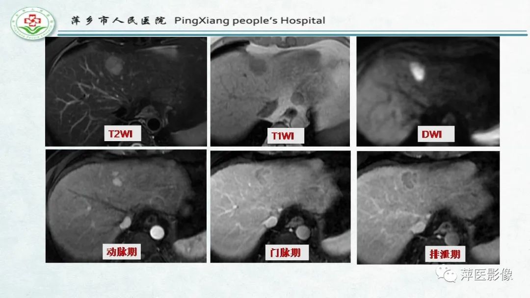 影像PPT - 【PPT】HCC影像诊断思路-40