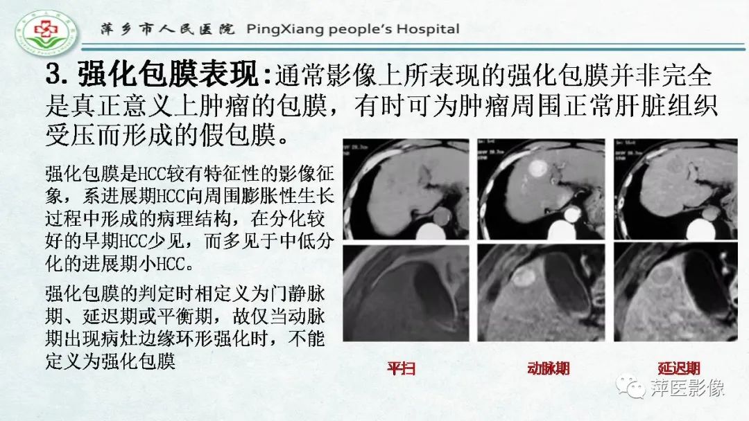影像PPT - 【PPT】HCC影像诊断思路-41