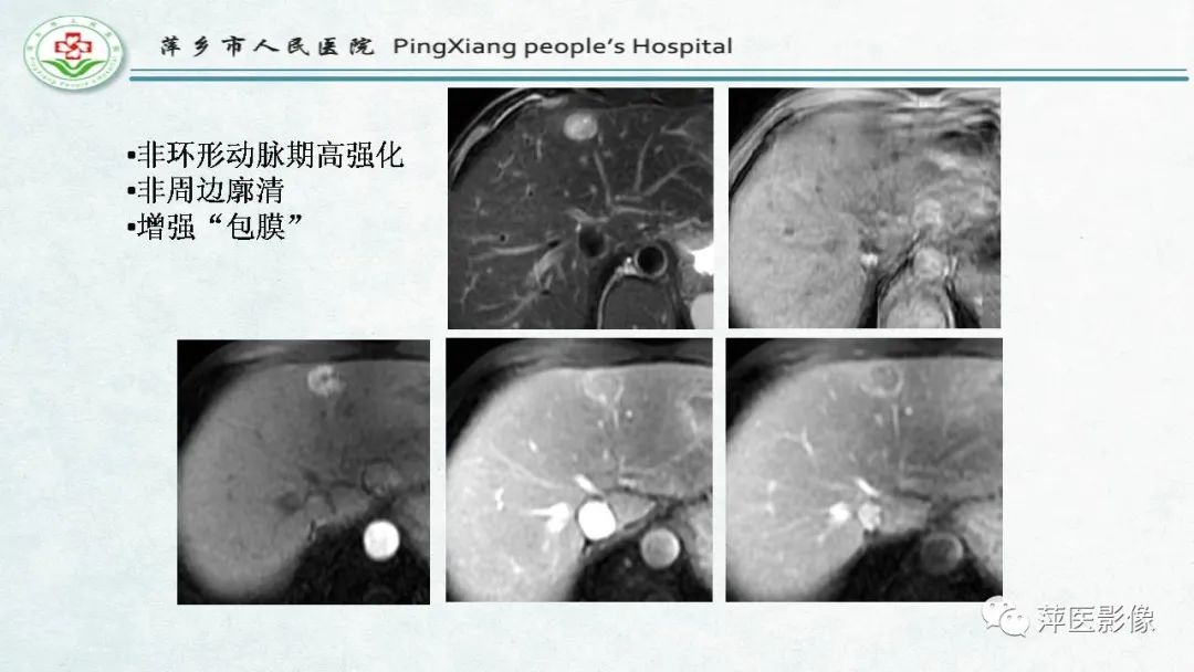 影像PPT - 【PPT】HCC影像诊断思路-42