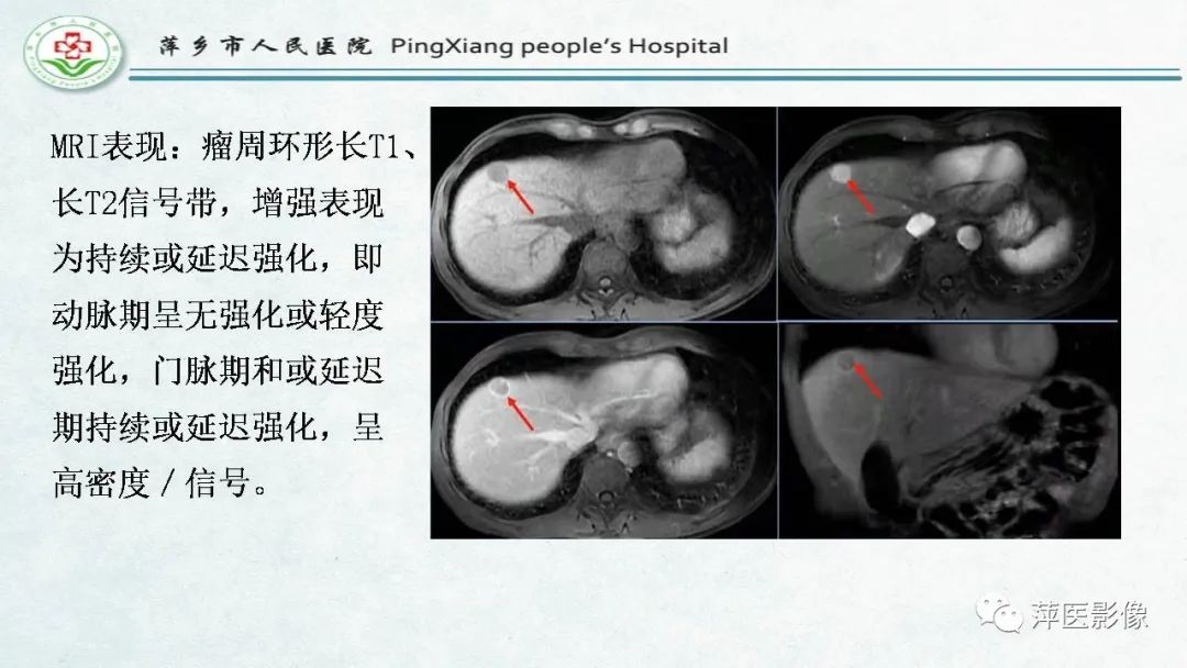 影像PPT - 【PPT】HCC影像诊断思路-43