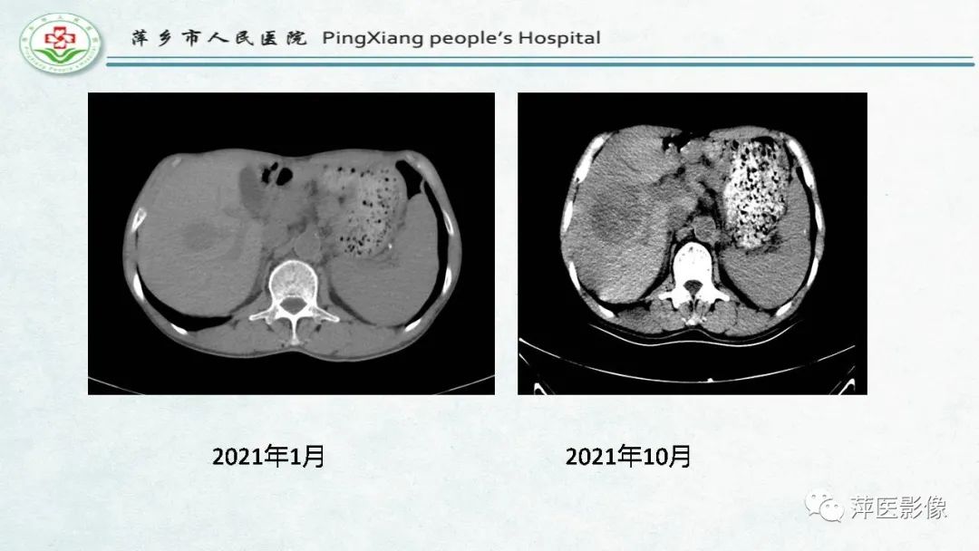 影像PPT - 【PPT】HCC影像诊断思路-45