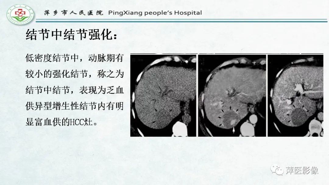 影像PPT - 【PPT】HCC影像诊断思路-48