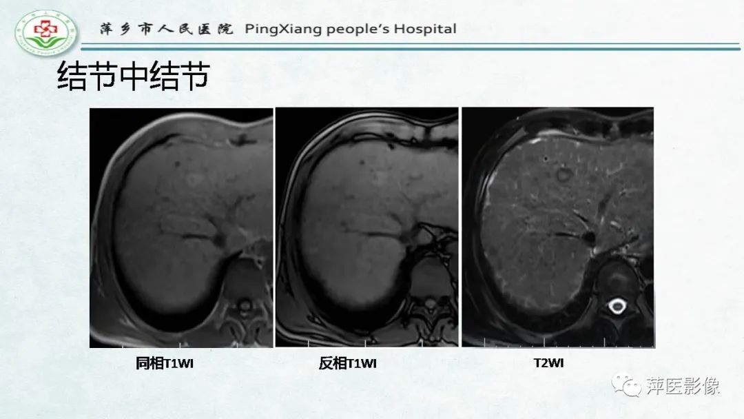 影像PPT - 【PPT】HCC影像诊断思路-49