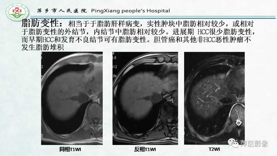 影像PPT - 【PPT】HCC影像诊断思路-50