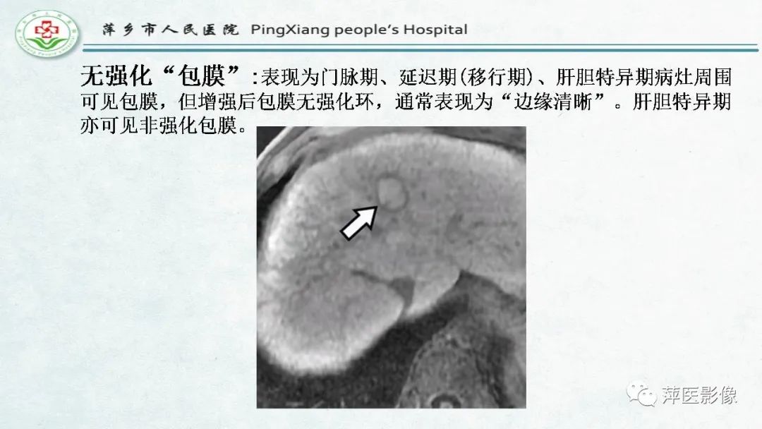 影像PPT - 【PPT】HCC影像诊断思路-52
