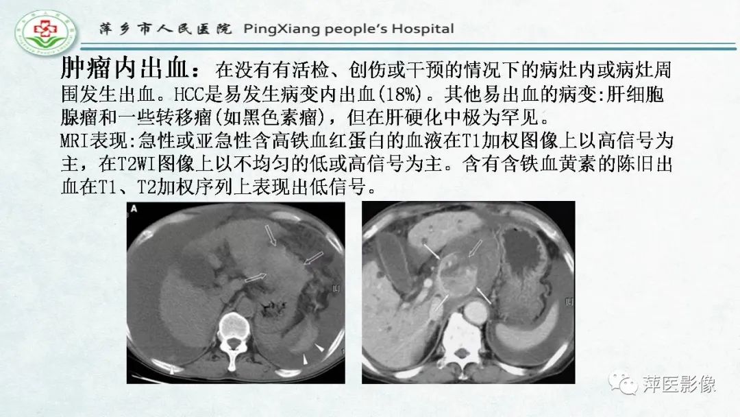 影像PPT - 【PPT】HCC影像诊断思路-53