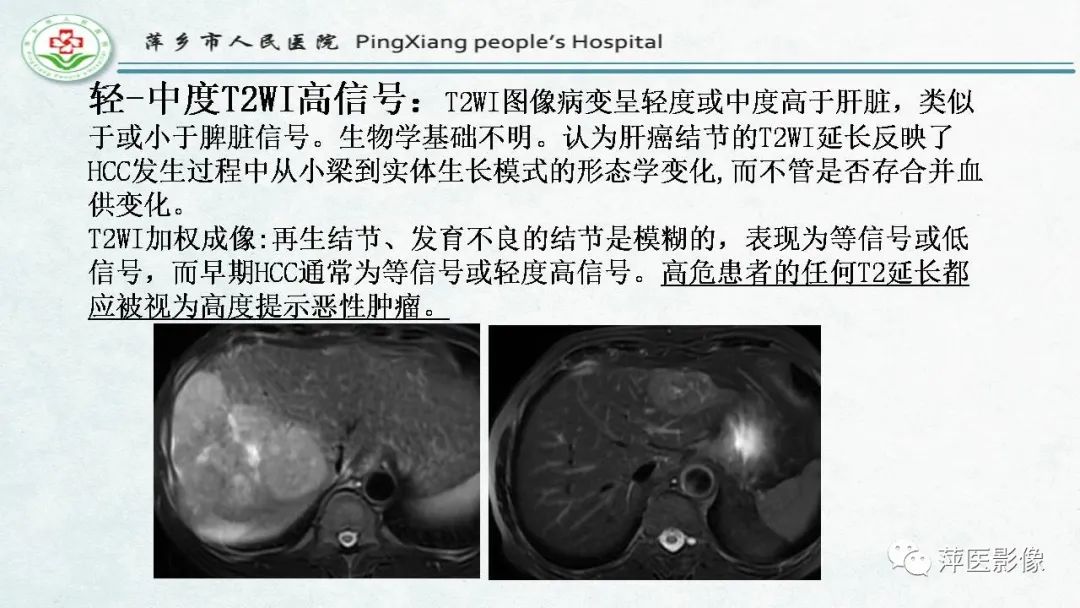 影像PPT - 【PPT】HCC影像诊断思路-54