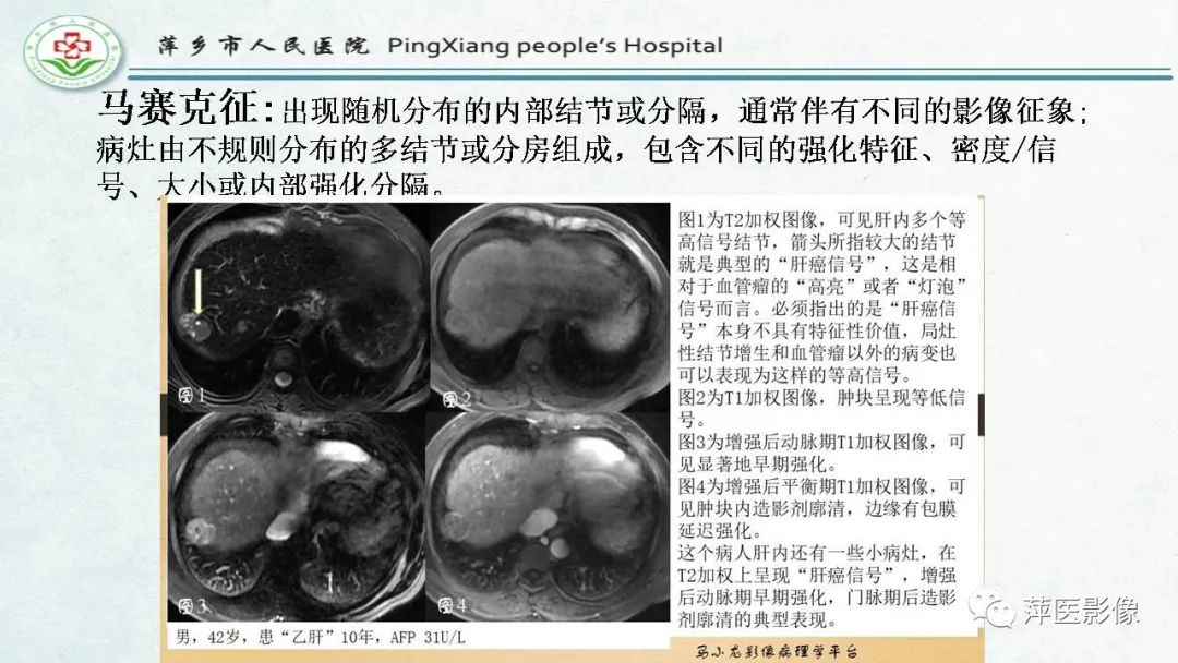 影像PPT - 【PPT】HCC影像诊断思路-55