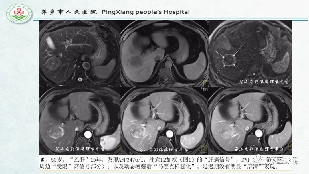影像PPT - 【PPT】HCC影像诊断思路-56