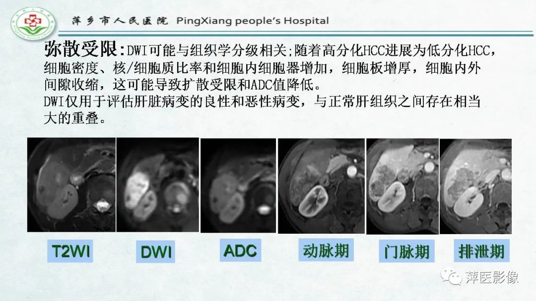 影像PPT - 【PPT】HCC影像诊断思路-57