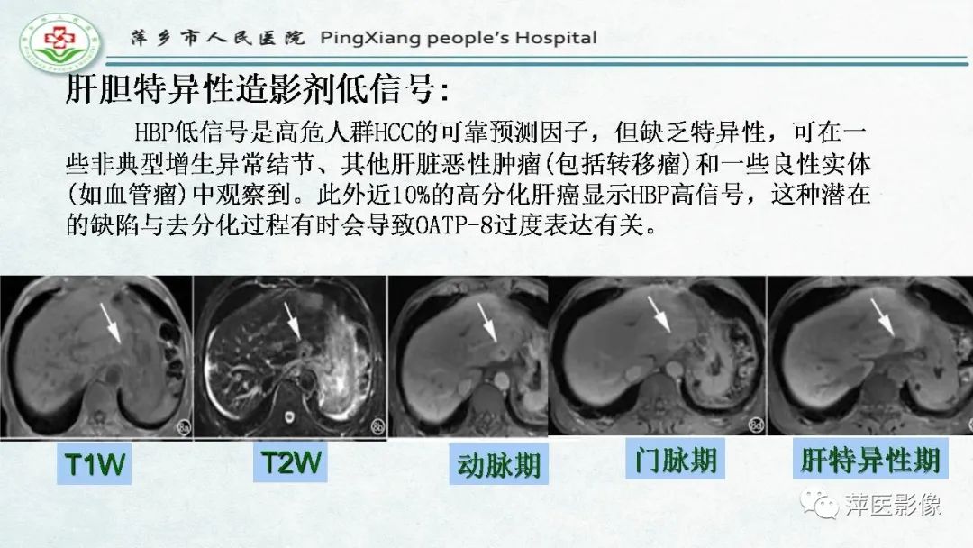 影像PPT - 【PPT】HCC影像诊断思路-58