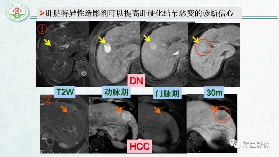 影像PPT - 【PPT】HCC影像诊断思路-59