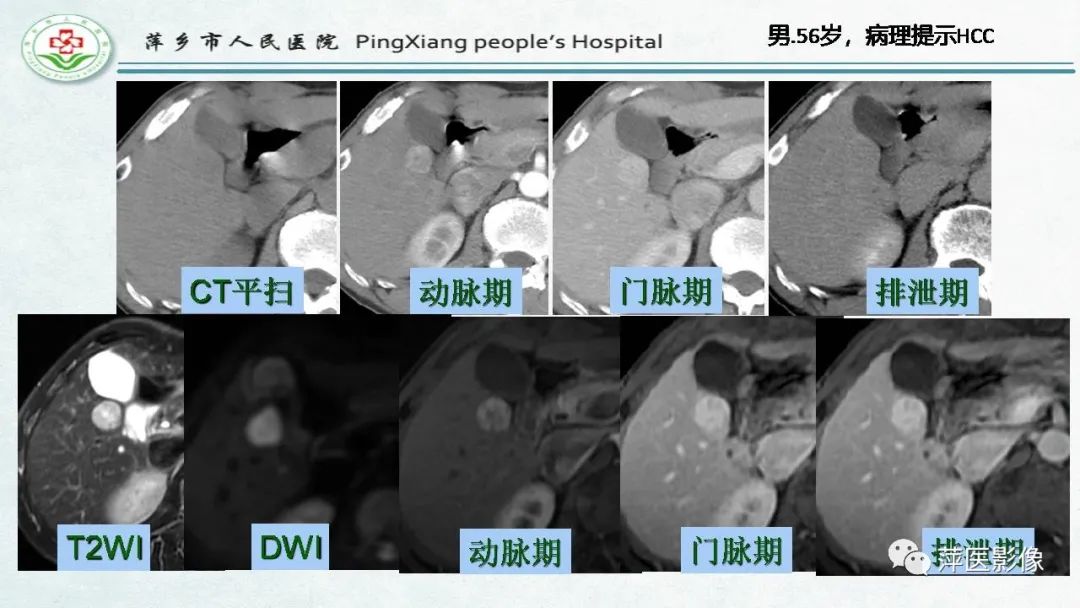 影像PPT - 【PPT】HCC影像诊断思路-60
