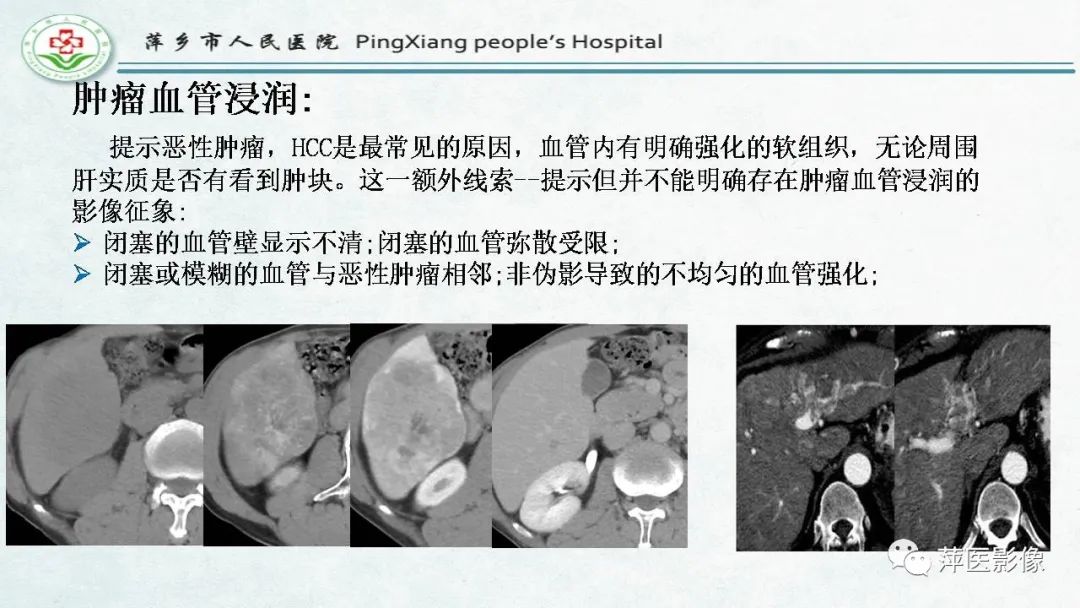 影像PPT - 【PPT】HCC影像诊断思路-61