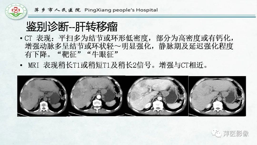 影像PPT - 【PPT】HCC影像诊断思路-68