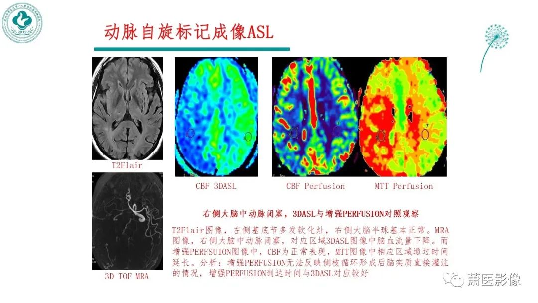 影像PPT - 【PPT】脑灌注成像原理及在临床中的应用-10
