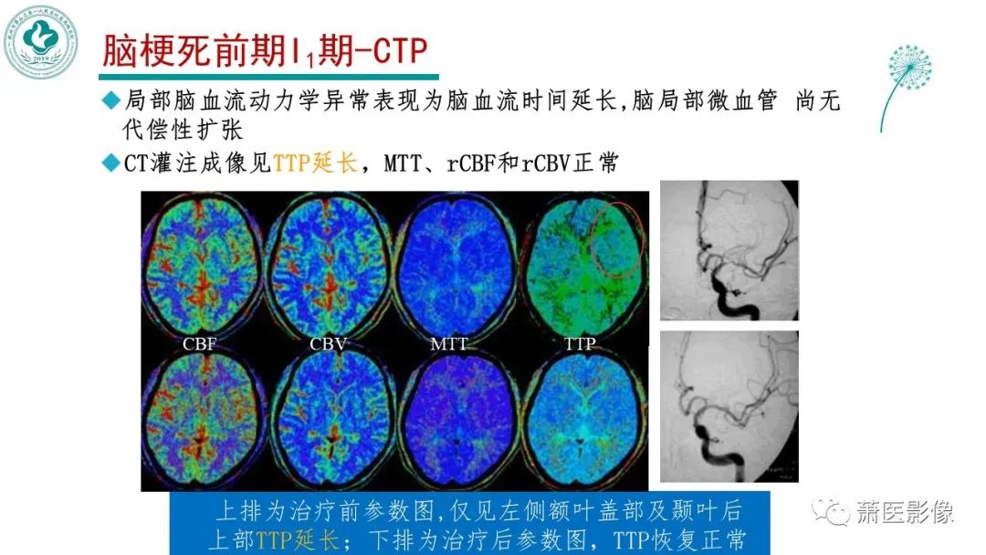 影像PPT - 【PPT】脑灌注成像原理及在临床中的应用-16