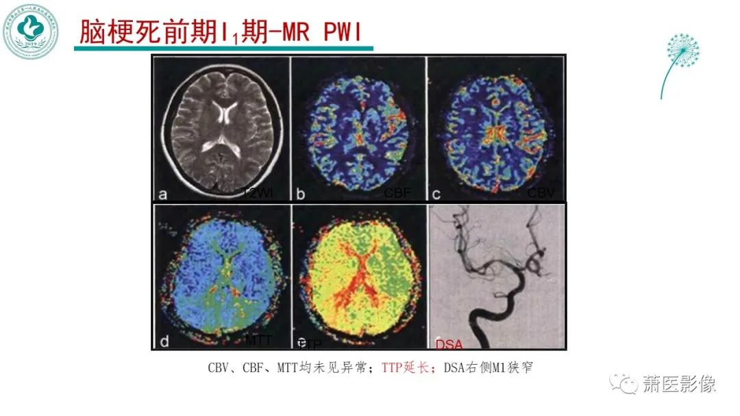 影像PPT - 【PPT】脑灌注成像原理及在临床中的应用-17